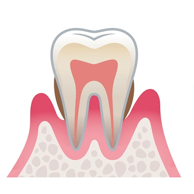 軽度歯周炎の歯周組織