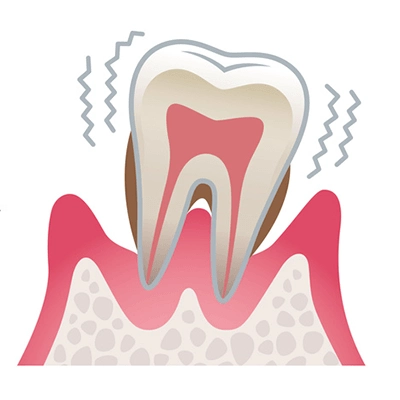 中等度歯周炎の歯周組織